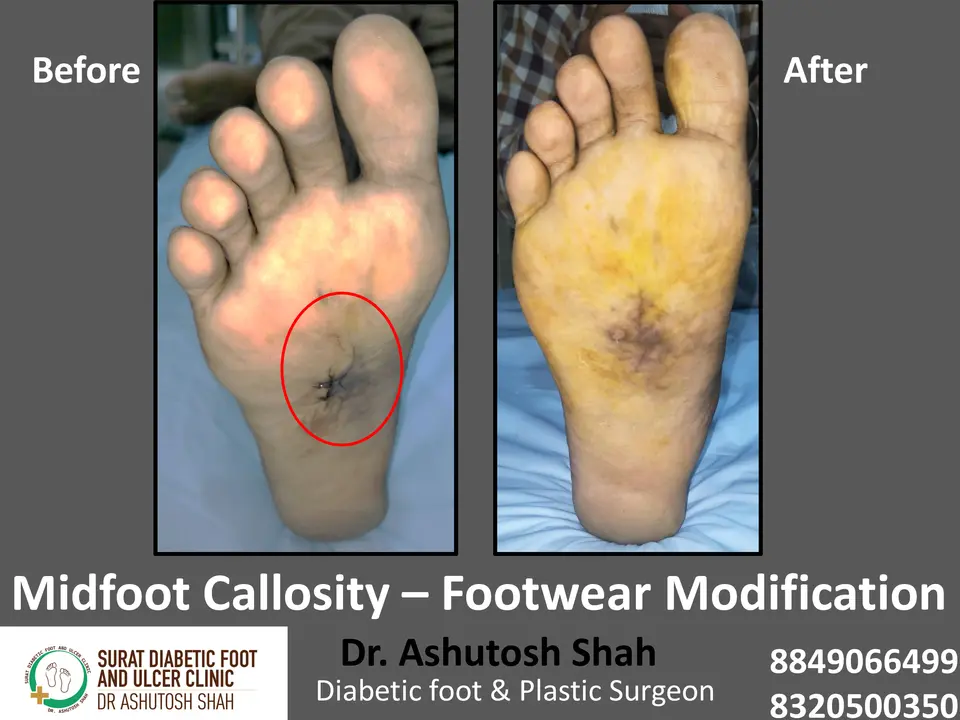 Diabetic Foot  PPT 3 checked by sir.pptx-62.webp